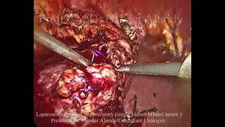 Laparoscopic partial tumor Nephrectomy single kidney and bifocal tumorاستئصال ورم الكلية الجزئي