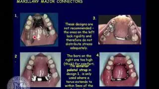 DENT 718: Classification and components of removable partial dentures