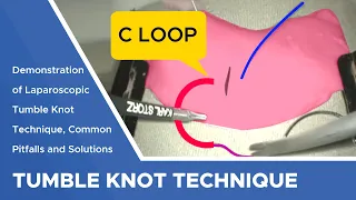 Suture Techniques and Training Series: Laparoscopic Tumble Knot Technique