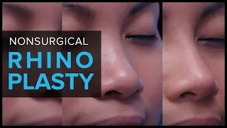 Non-Surgical Rhinoplasty in San Francisco