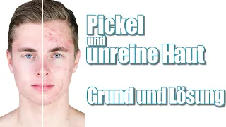 Pickel und unreine Haut los werden LÖSUNG und Grund