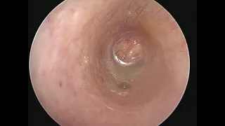 Endoscopic removal of cholesteatoma from Sadie's middle ear