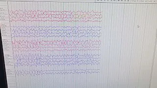 46 years old patient of loss of consciousness and confused behavior. EEG recording   delta burst..