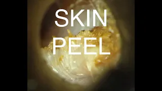 SKIN PEEL : EAR WAX REMOVAL : 4K/HD