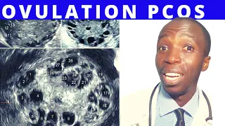 OVULATION WITH POLYCYSTIC OVARIAN SYNDROME | PCOS | Nucleus Health | Signs of Ovulation | CALENDER.