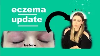 Eating a Plant Based Diet Cured My Eczema + Reduced Cellulite