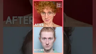 [SHORTS]Facial Feminization Surgery (FFS) in Korea Plastic Surgery Hospital | Before & After Results