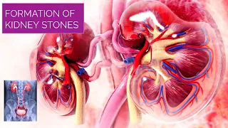 Formation of Kidney Stones | Kidney Stones Treatment | Kidney Stones 3D Animation