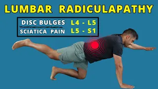 Lumbar Radiculopathy L4 L5 - L5 S1 exercises for pain relief