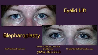 Eyelid Lift (Blepharoplasty) San Francisco - Part 2 of 2