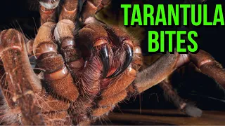 TARANTULA BITE: First Aid, Symptoms & Prevention