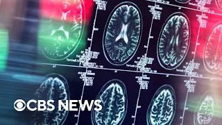 Teens' brains aged faster during the pandemic, study shows