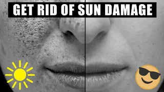 HOW TO GET RID OF SUN DAMAGE