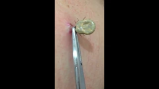 Tick removal by US doctor