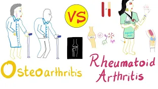 Rheumatoid Arthritis (RA) vs Osteoarthritis (OA)