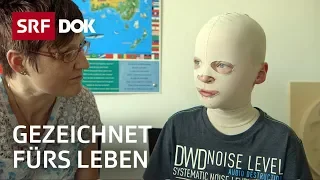 Brandmal – Gezeichnet fürs Leben | Schwere Verbrennungen bei Kindern | Doku | SRF Dok