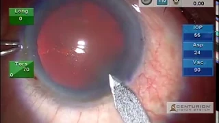 Topical + Intracameral - Clear Corneal Incision