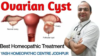 Polycystic Ovary syndrome |PCOD | PCOS infertility homeopathic treatment jodhpur| Cause symptoms