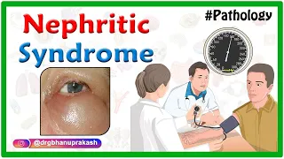 Overview of Nephritic Syndrome / Nephrotic vs Nephritic Syndrome - USMLE Step 1