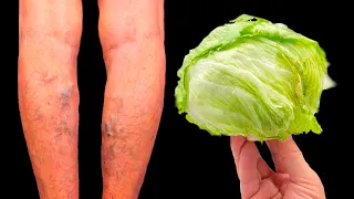 🤩 Get rid of varicose veins forever! Just put in cabbage leaves and wait