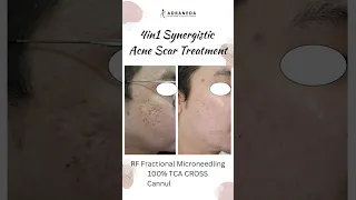 4in1 Synergistic Acne Scar Treatment RF fractional microneedling, Cannula subcision, TCA CROSS, PRP