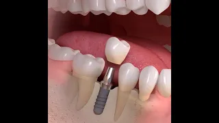 Implantologia  Trattamento singolo dente su impianto