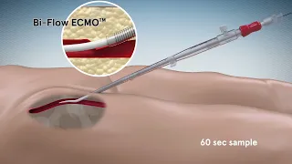 Bi-Flow Bidirectional cannula animation by Aarons CGI 3D animation studio Melbourne - 1 min sample