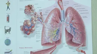 Robotic Lobectomy for Lung Cancer Treatment