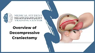 Overview of Decompressive Craniectomy