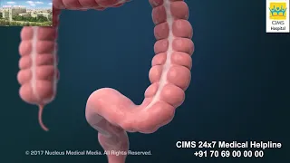 Treatments for Colorectal Cancer – CIMS Hospital
