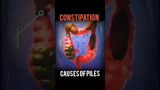 Constipation- Causes Of Piles
