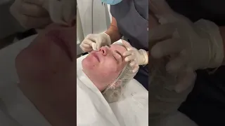 #short Salicylic skin peel in action | sk:n Clinics