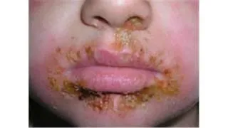 impetigo