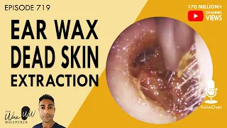 719 - Ear Wax Dead Skin Extraction