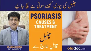 Psoriasis Skin Disease - Psoriasis Kya Hai - Chumbal Ka Ilaj - Psoriasis Causes & Treatment In Urdu