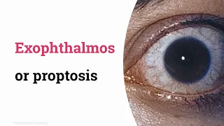 Exophthalmos