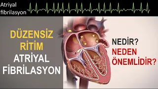 Düzensiz Ritim: Atriyal Fibrilasyon (AF) Nedir, Neden Önemlidir?