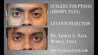 Levator Resection LPSR - Surgery for Droopy Eyes: Dr Akshay Nair - Scarless, Painless and Bloodless.