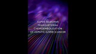 Transarterial CHemoEmbolisation of liver cancer/ tumour - TACE #interventionalradiology #youtube