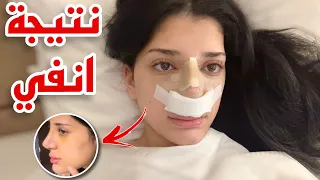 اخيرا نتيجة انفي بعد عملية التجميل.. 👃🏻