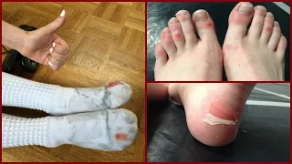 How To Deal With Blisters From Dance Class | Dancer Problems