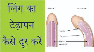 लिंग का टेढ़ापन कैसे दूर करें | Dr. Nizamuddin Qasmi