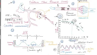 Coronary Angiogram . FFR (Fractional Flow Reserve)