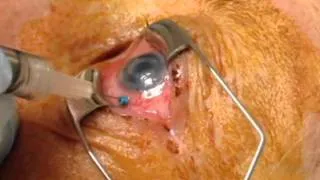 Tap and Inject for Endophthalmitis using 25G Trocar Cannula