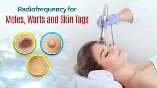 Is Radio Frequency Surgery safe for removing Moles, Warts, Skin Tags