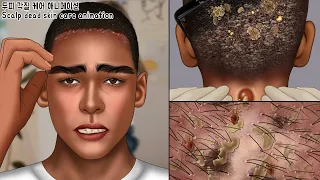 ASMR dead skin explosion! Big Flakes Dandruff Scratching Animation| Head Lice | sebaceous cyst