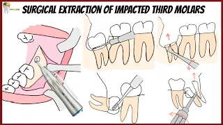 Surgical extraction of IMPACTED mandibular third molars | Horizontal, mesioangular, distoangular