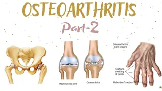 OSTEOARTHRITIS || PART-2 || DEGENERATIVE JOINT DISEASE || PRIMARY & SECONDARY OSTEOARTHRITIS
