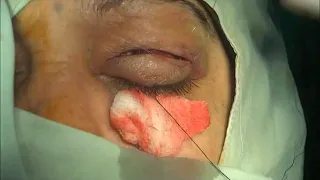 Upper lid blepharotomy for correction of lid retraction By Dr: Ezzat Nabil MD