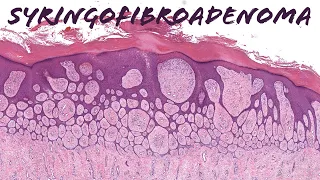 Eccrine Syringofibroadenoma - rare skin adnexal tumor/pattern (dermpath dermatology pathology)